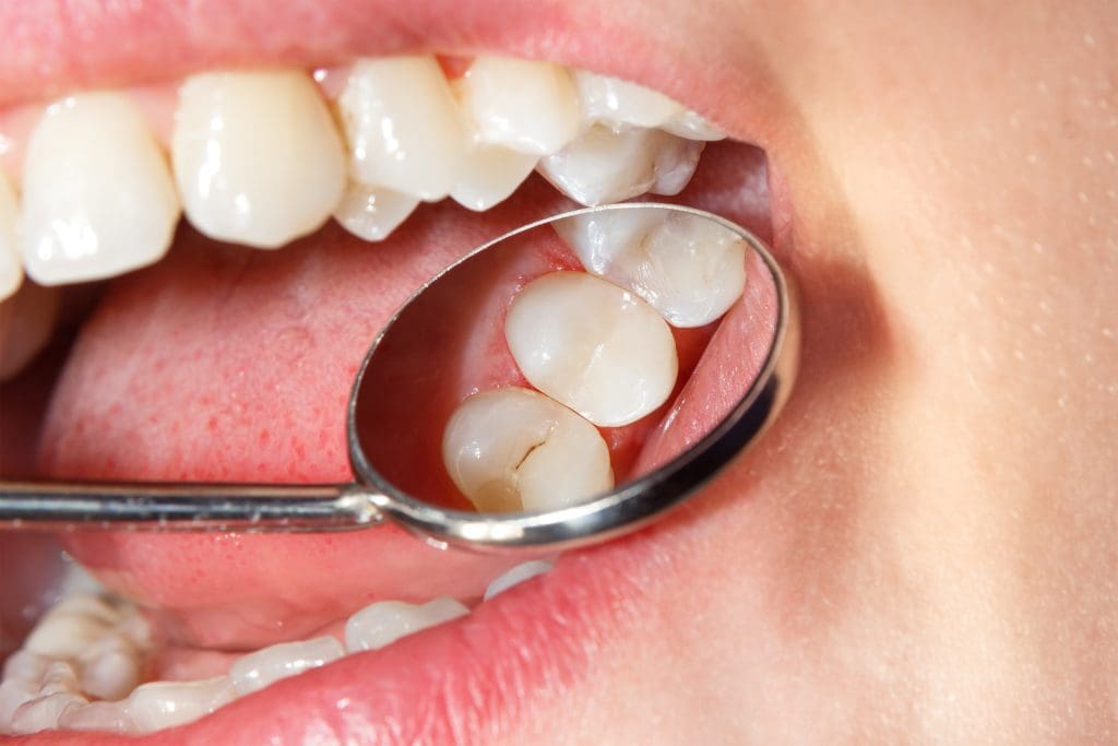 Dental Filling Procedure: What To Expect