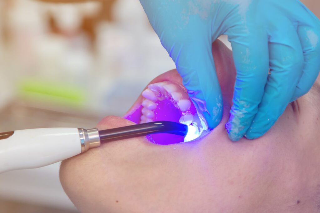 Dentist curing tooth filling with blue wavelength light