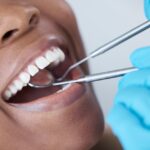 How Long Do Cavities Take to Fill?