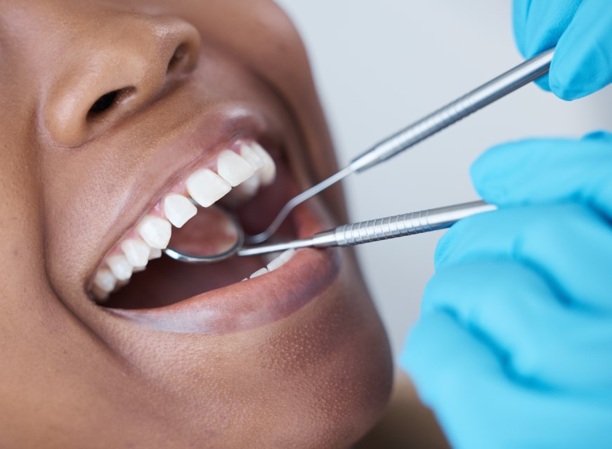 How Long Do Cavities Take to Fill?