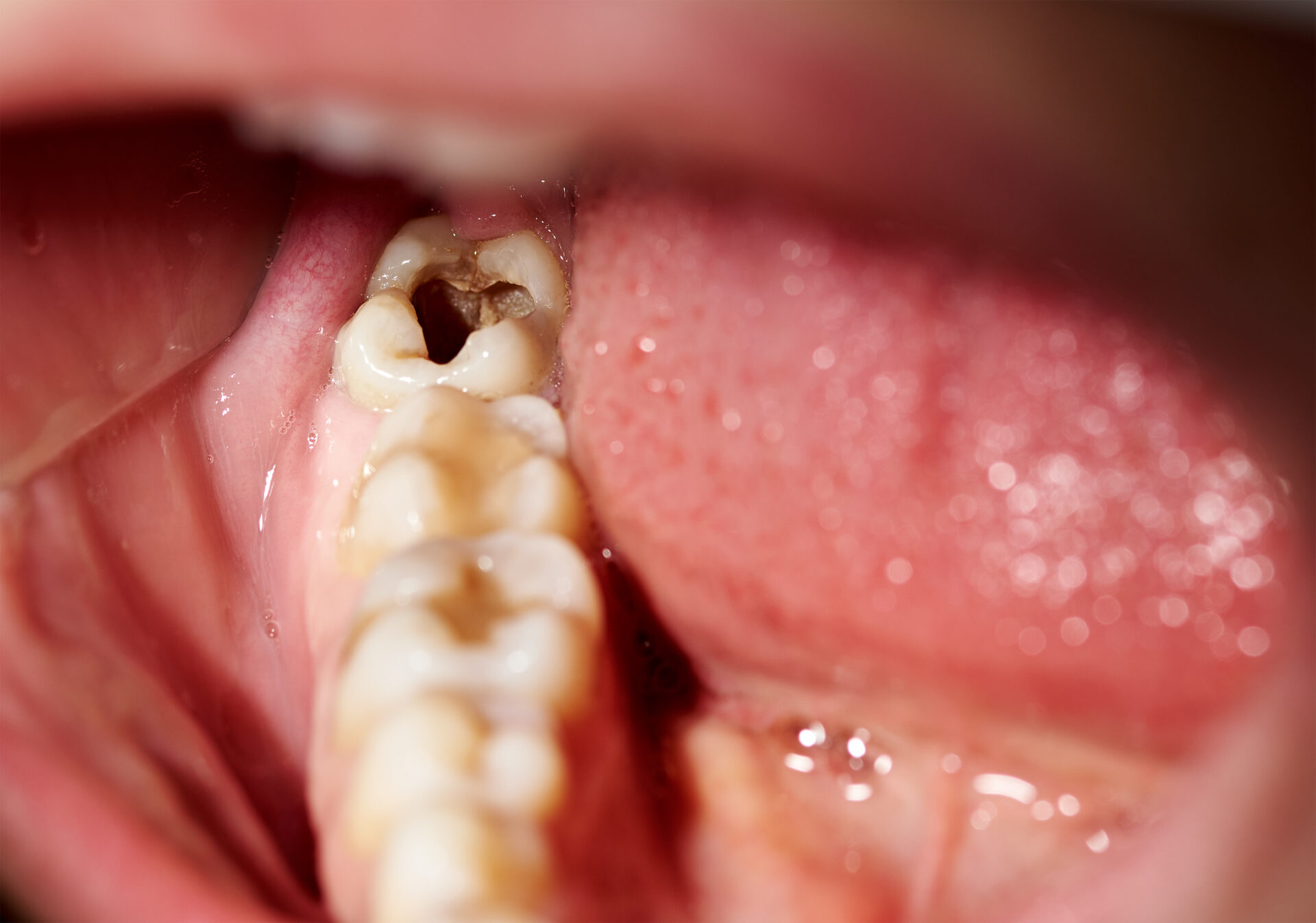 symptoms of cavities