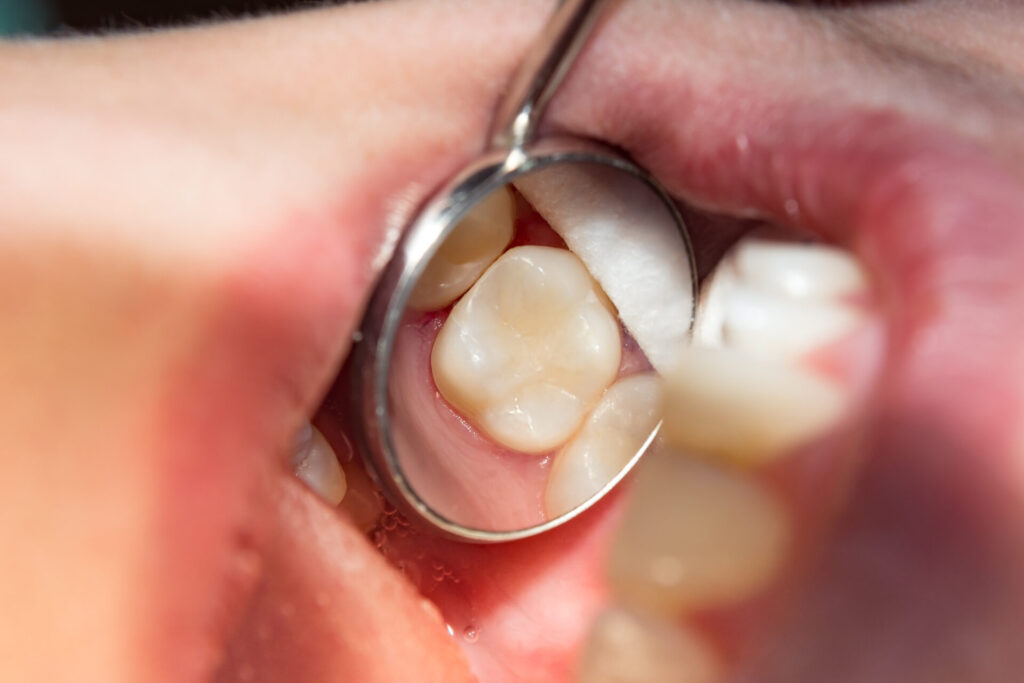Read more on How Long Do Fillings Usually Last? The Ultimate Guide