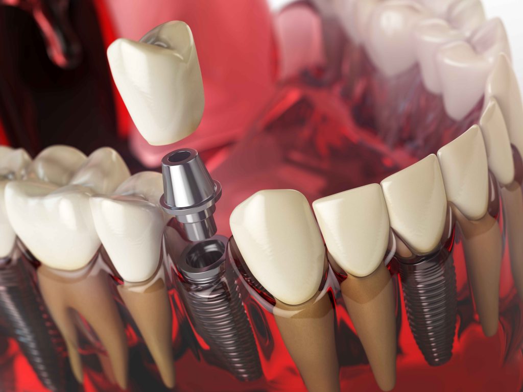 Read more on Dental Implants in Penticton: Why Enamel Dental is Your Best Choice