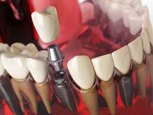 Read more on Dental Implants in Penticton: Why Enamel Dental is Your Best Choice