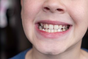 Read more on What Causes White Spots on Teeth? Common Reasons & Solutions
