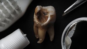 Read more on The 5 Stages of Tooth Decay and How to Treat Each Stage