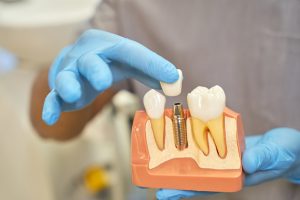 Read more on Dental Implants vs Dentures: Crowns, Implant Crowns & Tooth Replacement Options in Penticton